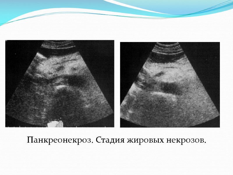 Панкреонекроз. Стадия жировых некрозов.